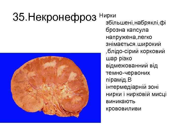 35. Некронефроз Нирки збільшені, набряклі, фі брозна капсула напружена, легко знімається. широкий , блідо