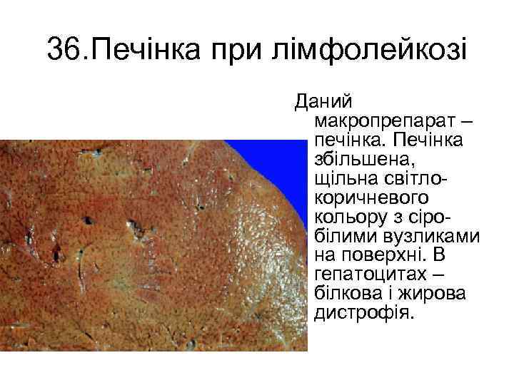 36. Печінка при лімфолейкозі Даний макропрепарат – печінка. Печінка збільшена, щільна світло коричневого кольору