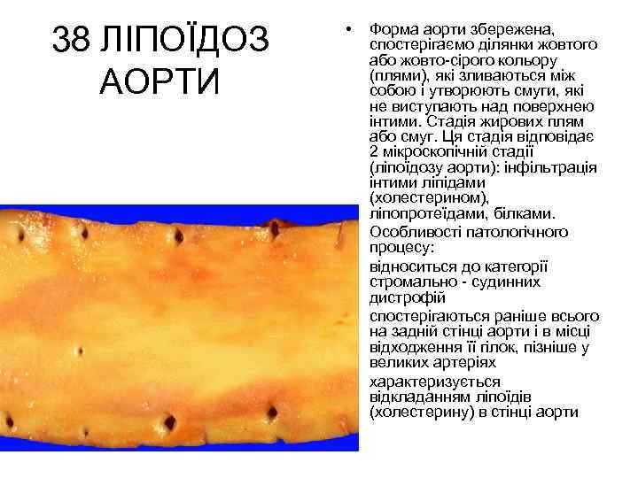 38 ЛІПОЇДОЗ АОРТИ • • • Форма аорти збережена, спостерігаємо ділянки жовтого або жовто