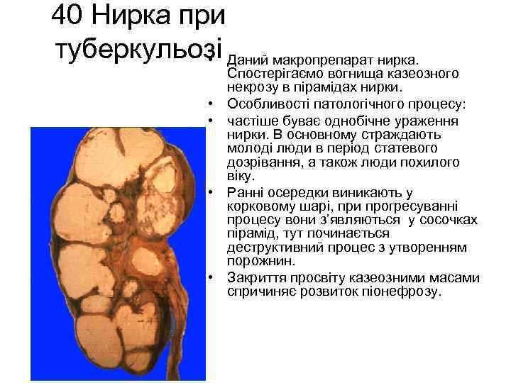 40 Нирка при туберкульозі Даний макропрепарат нирка. • • • Спостерігаємо вогнища казеозного некрозу