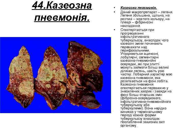 44. Казеозна пневмонія. • • • Казеозна пневмонія. Даний макропрепарат – легеня. Легеня збільшена,