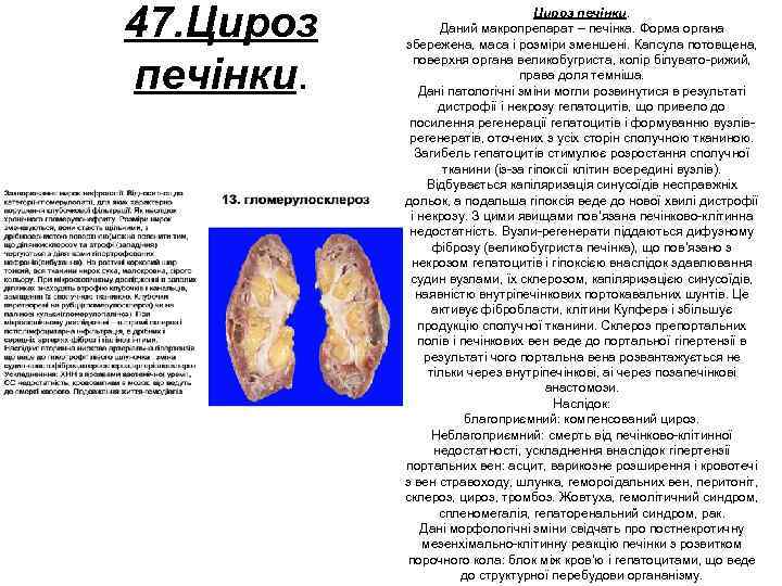 47. Цироз печінки. Даний макропрепарат – печінка. Форма органа збережена, маса і розміри зменшені.