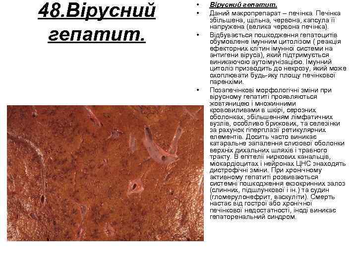 48. Вірусний гепатит. • • Вірусний гепатит. Даний макропрепарат – печінка. Печінка збільшена, щільна,