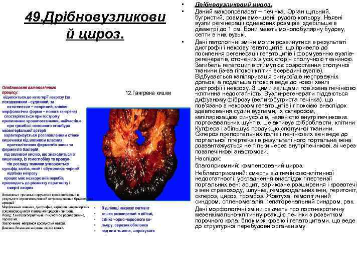 49. Дрібновузликови й цироз. • • Дрібновузликовий цироз. Даний макропрепарат – печінка. Орган щільний,