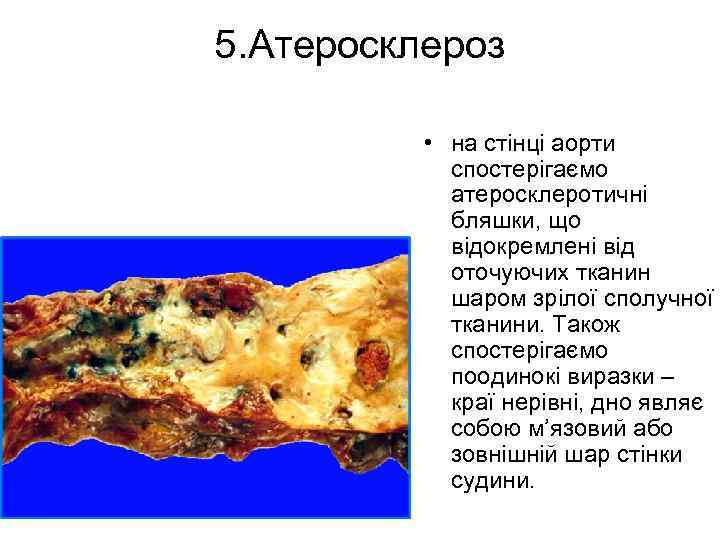 5. Атеросклероз • на стінці аорти спостерігаємо атеросклеротичні бляшки, що відокремлені від оточуючих тканин