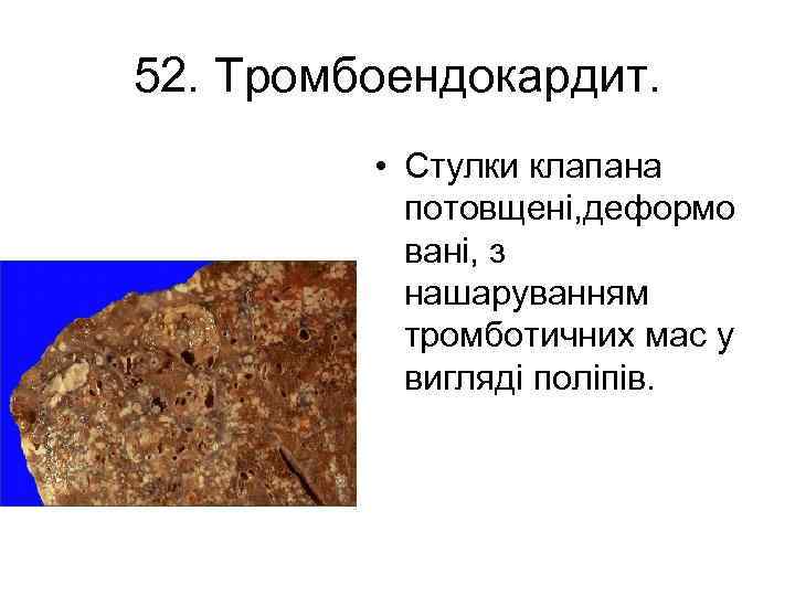 52. Тромбоендокардит. • Стулки клапана потовщені, деформо вані, з нашаруванням тромботичних мас у вигляді