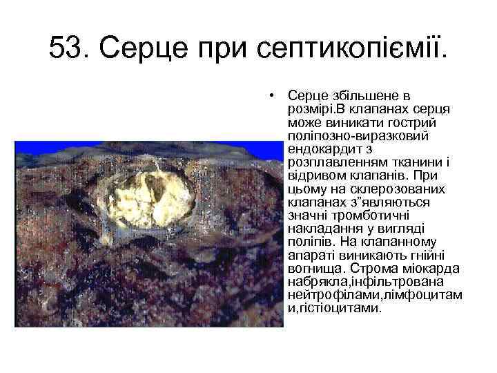 53. Серце при септикопіємії. • Серце збільшене в розмірі. В клапанах серця може виникати