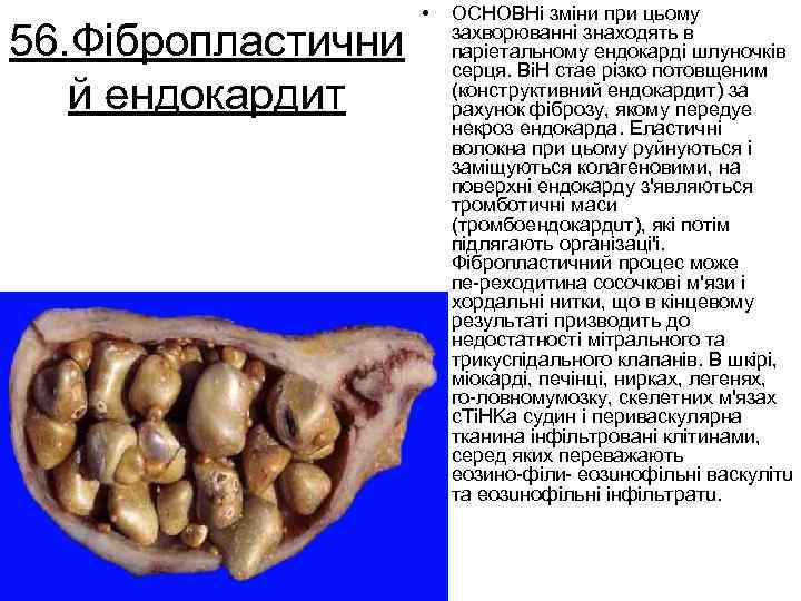 56. Фібропластични й ендокардит • OCHOBHi змiни при цьому захворюваннi знаходять в парiетальному ендокардi