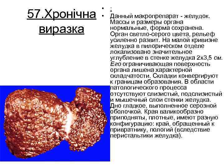 57. Хронічна виразка • : • Данный макропрепарат желудок. Массы и размеры органа нормальные,