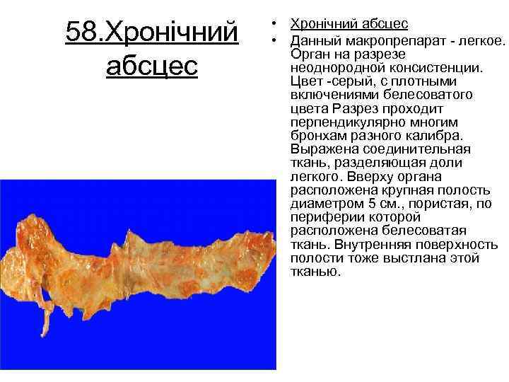 58. Хронічний абсцес • Хронічний абсцес • Данный макропрепарат легкое. Орган на разрезе неоднородной