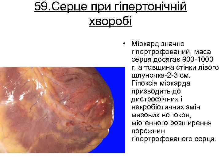 59. Серце при гіпертонічній хворобі • Міокард значно гіпертрофований, маса серця досягає 900 1000