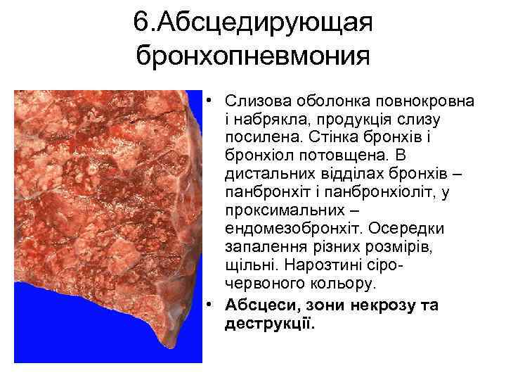 6. Абсцедирующая бронхопневмония • Слизова оболонка повнокровна і набрякла, продукція слизу посилена. Стінка бронхів