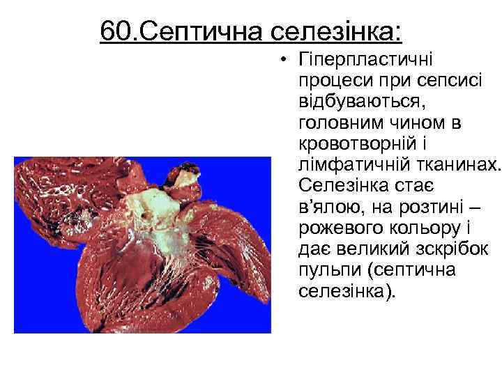 60. Септична селезінка: • Гіперпластичні процеси при сепсисі відбуваються, головним чином в кровотворній і