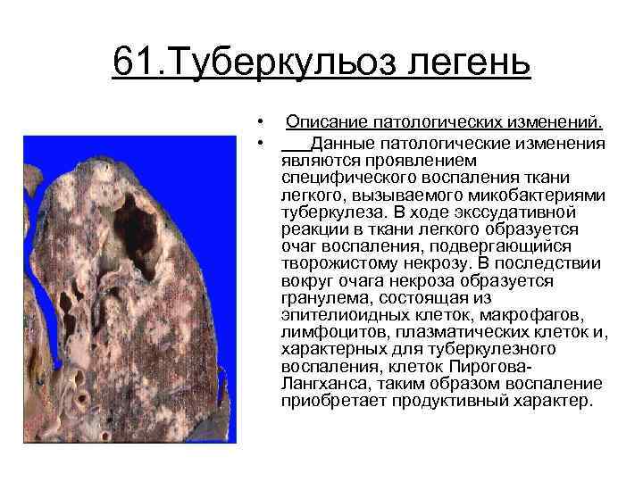 Патологические изменения. Туберкулома структуры. Туберкулома легкого строение.