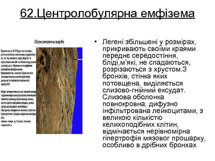 62. Центролобулярна емфізема • Легені збільшені у розмірах, прикривають своїми краями переднє середостіння, бліді,