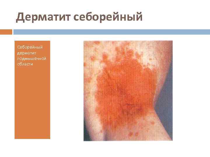 Дерматит себорейный Cеборейный дерматит подмышечной области 