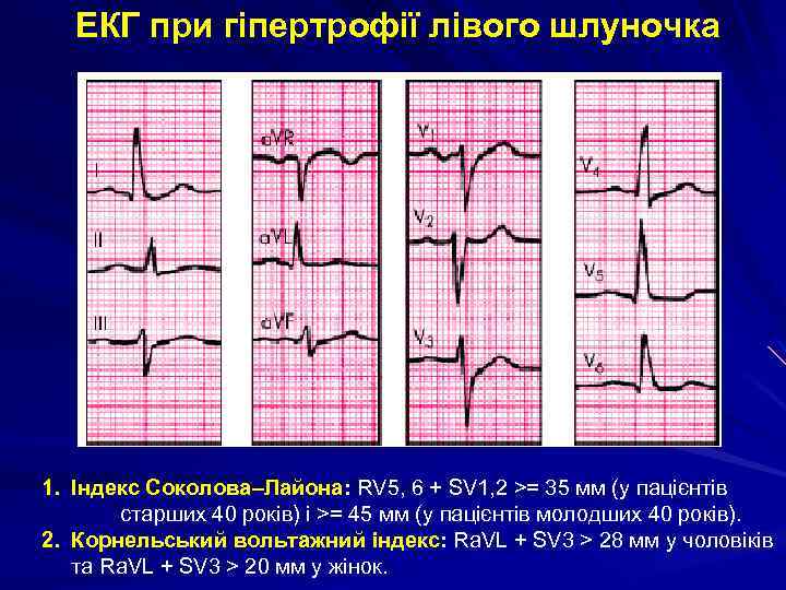  ЕКГ при гіпертрофії лівого шлуночка 1. Індекс Соколова–Лайона: RV 5, 6 + SV