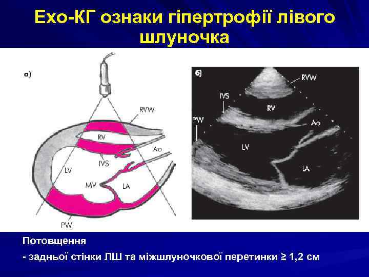 Ехо-КГ ознаки гіпертрофії лівого шлуночка Потовщення - задньої стінки ЛШ та міжшлуночкової перетинки ≥