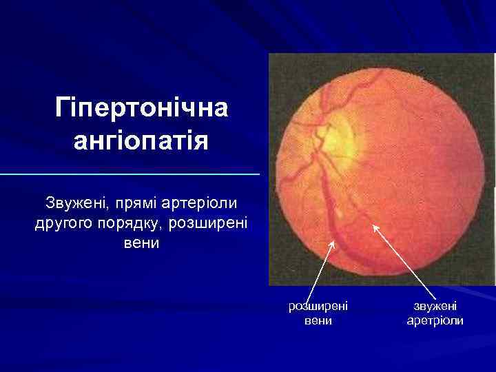 Гіпертонічна ангіопатія Звужені, прямі артеріоли другого порядку, розширені вени звужені аретріоли 