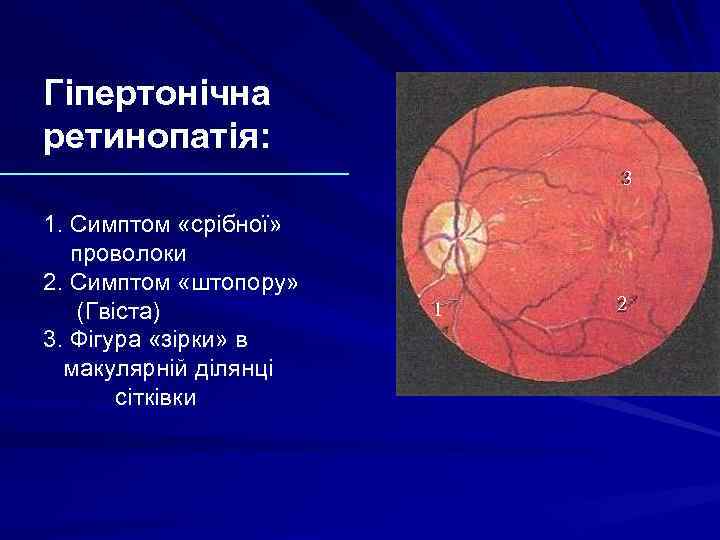 Гіпертонічна ретинопатія: 3 1. Симптом «срібної» проволоки 2. Симптом «штопору» (Гвіста) 3. Фігура «зірки»