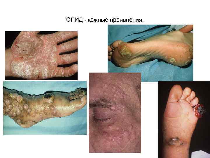 СПИД - кожные проявления. 