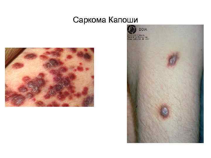 Саркома Капоши 