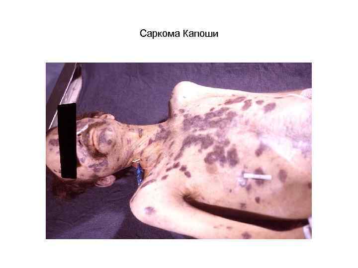 Саркома Капоши 