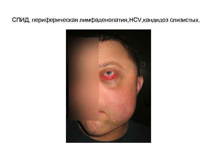 СПИД, периферическая лимфаденопатия, HCV, кандидоз слизистых. 