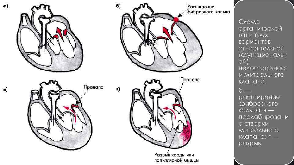 Сердечная недостаточность митрального клапана. Приобретённые пороки сердца недостаточность митрального клапана. Стеноз митрального клапана гемодинамика схема. Приобретенные пороки сердца схема. Приобретенные митральные пороки сердца.