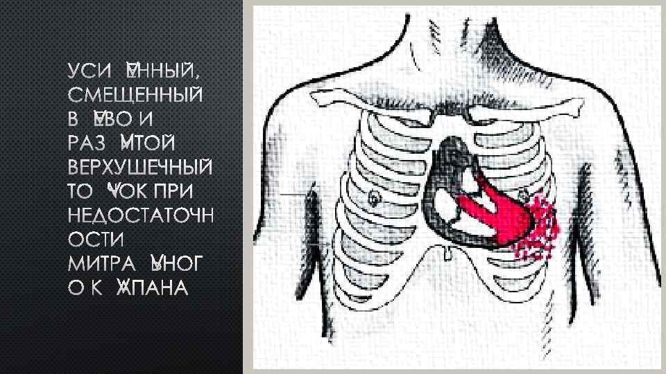 УСИЛЕННЫЙ, СМЕЩЕННЫЙ ВЛЕВО И РАЗЛИТОЙ ВЕРХУШЕЧНЫЙ ТОЛЧОК ПРИ НЕДОСТАТОЧН ОСТИ МИТРАЛЬНОГ О КЛАПАНА 