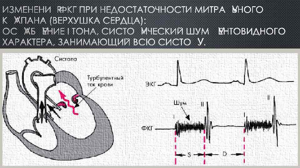 ИЗМЕНЕНИЯ ФКГ ПРИ НЕДОСТАТОЧНОСТИ МИТРАЛЬНОГО КЛАПАНА (ВЕРХУШКА СЕРДЦА): ОСЛАБЛЕНИЕ I ТОНА, СИСТОЛИЧЕСКИЙ ШУМ ЛЕНТОВИДНОГО