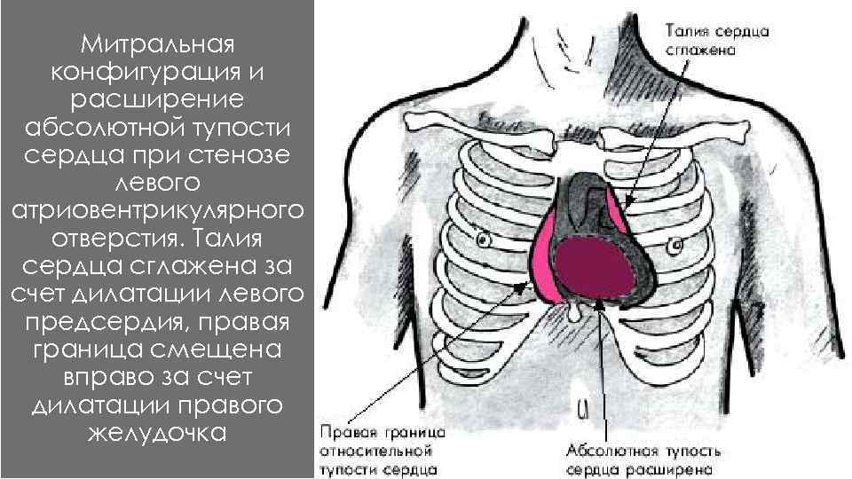 Тупость сердца. Абсолютная тупость сердца при митральной недостаточности. Абсолютная тупость сердца при митральном стенозе. Митральная конфигурация сердца при митральном стенозе. Конфигурация сердца талия сглажена.