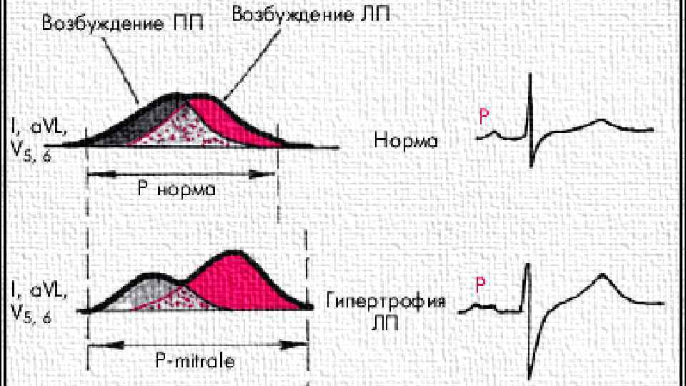 ГИПЕРТРОФИЯ ЛЕВОГО ПРЕДСЕРДИЯ. ЭЛЕКТРОКАРДИОГРАФИЯ • РАЗДВОЕНИЕ И НЕБОЛЬШОЕ УВЕЛИЧЕНИЕ АМПЛИТУДЫ ЗУБЦОВ Р В ОТВЕДЕНИЯХ