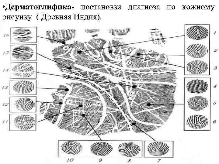  • Дерматоглифика- постановка диагноза по кожному рисунку ( Древняя Индия). 