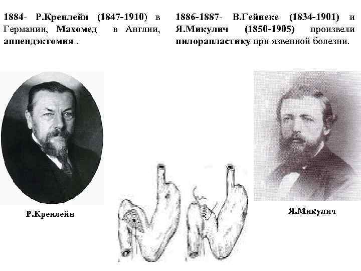 1884 - Р. Кренлейн (1847 -1910) в Германии, Махомед в Англии, аппендэктомия. Р. Кренлейн