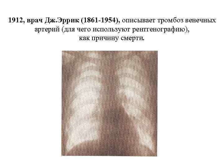 1912, врач Дж. Эррик (1861 -1954), описывает тромбоз венечных артерий (для чего используют рентгенографию),