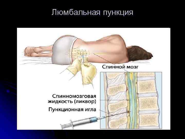 Люмбальная пункция 