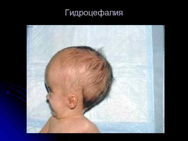 Гидроцефалия 