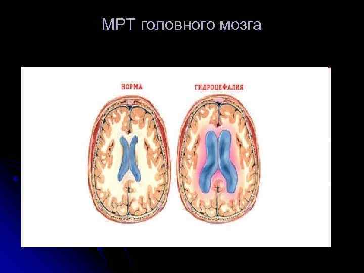 МРТ головного мозга 