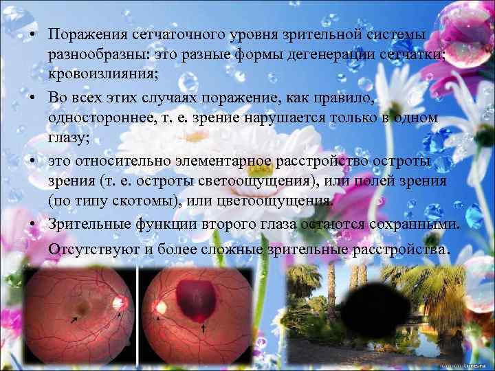  • Поражения сетчаточного уровня зрительной системы разнообразны: это разные формы дегенерации сетчатки; кровоизлияния;