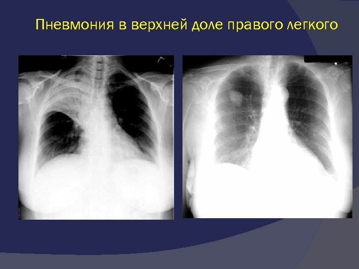 Пневмония верхней доли легкого. Правосторонняя очаговая пневмония рентген. Крупозная долевая пневмония. Правосторонняя верхнедолевая крупозная пневмония.. Пневмония верхней доли левого легкого рентген.