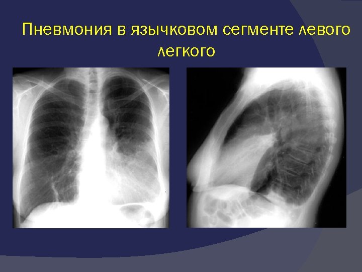 Язычковые сегменты левого. Сегментарная пневмония рентген. Пневмония рентген сегменте. Пневмония нижней доли левого легкого рентген. Сегментарная пневмония у детей рентген.