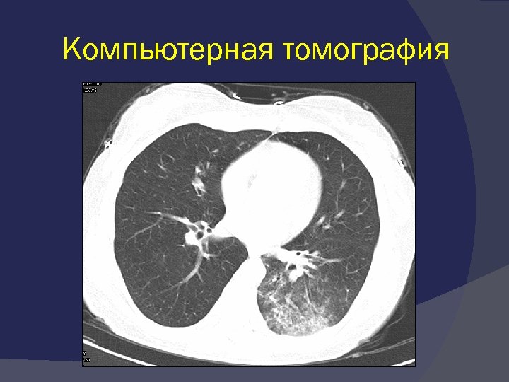 Кт картина пневмонии