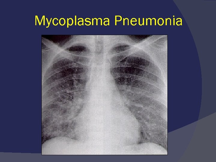 Микоплазменная пневмония это. Микоплазменная пневмония рентген. Микоплазма пневмония рентгенография. Микоплазменная пневмония рентгенограмма. Атипичная микоплазменная пневмония.