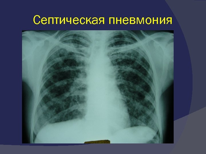Септическая пневмония 