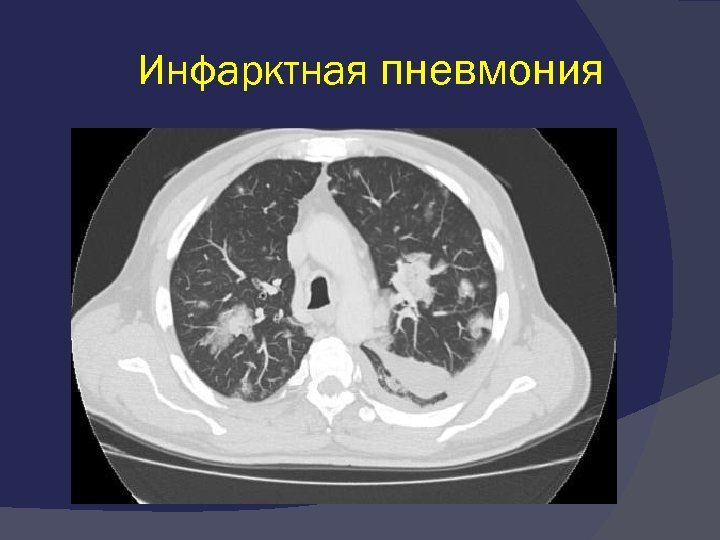 Инфарктная пневмония 