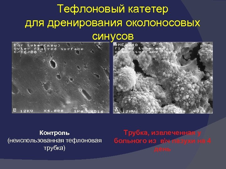 Тефлоновый катетер для дренирования околоносовых синусов Контроль (неиспользованная тефлоновая трубка) Трубка, извлеченная у больного