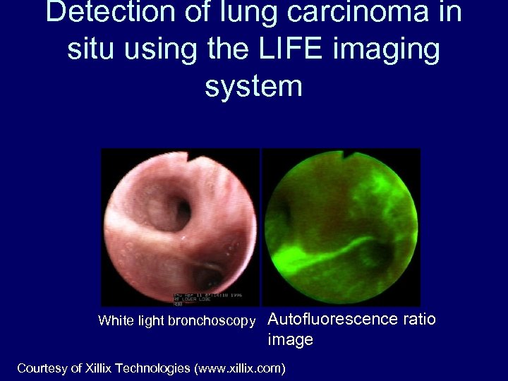 Detection of lung carcinoma in situ using the LIFE imaging system White light bronchoscopy