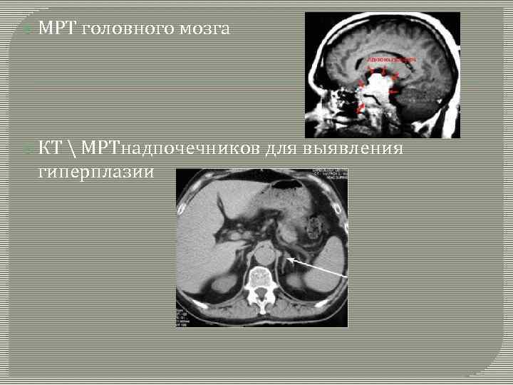  МРТ головного мозга КТ  МРТнадпочечников для выявления гиперплазии 