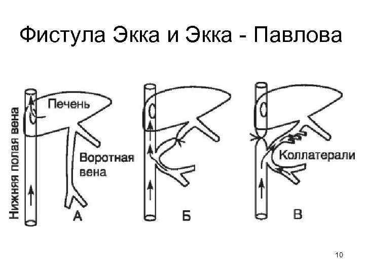 Фистула Экка и Экка - Павлова 10 